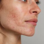 nærbilde av kvinne med voksenakne