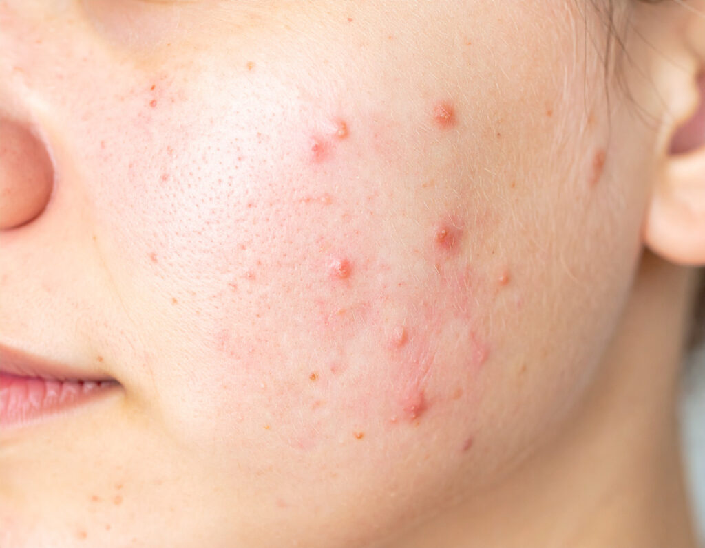 Nærbilde av fet hudtype med acne i kinn