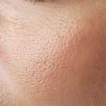 Nærbilde av fet hudtype med synlige porer