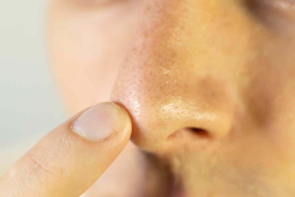 mann med kombinert hudtype som holder fingen på nesen